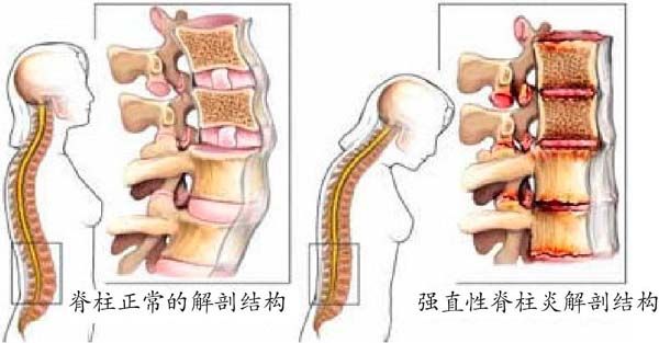 强直性脊柱炎症状1