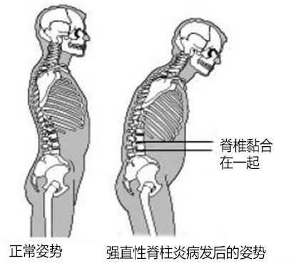 强直性脊柱炎16.jpg