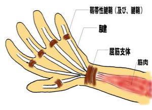 急性纤维性腱鞘炎