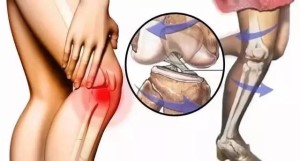膝关节韧带损伤怎么办.jpg